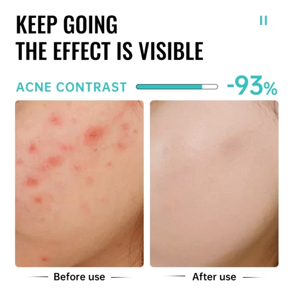 Salicylic Acid Acne Treatment Face Cream Repair Pimple Spots Deep Cleaning Pore Anti-acne Scar Oil Control Moisturizer Skin Care - Image 4