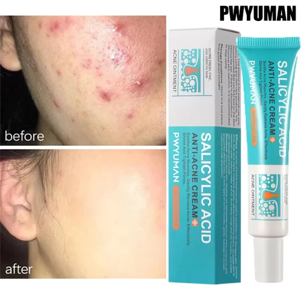 Salicylic Acid Acne Treatment Face Cream Repair Pimple Spots Deep Cleaning Pore Anti-acne Scar Oil Control Moisturizer Skin Care - Image 2